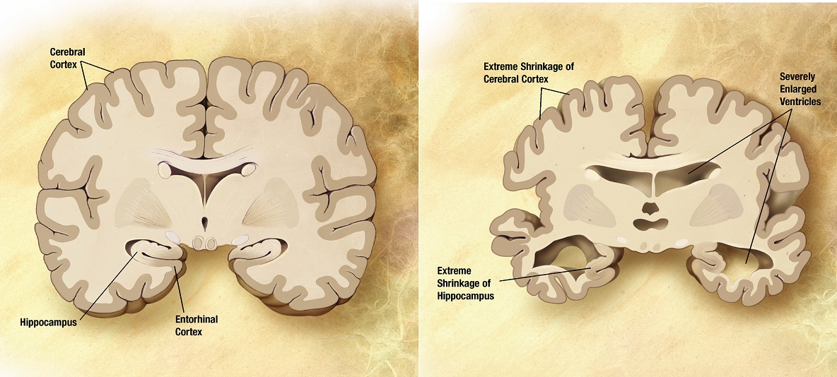 Porovnanie zdravĂ©ho mozgu a mozgu pacienta s Alzheimerovou chorobou (vpravo). Kredit: PD-USGov